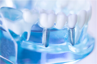 インプラント治療