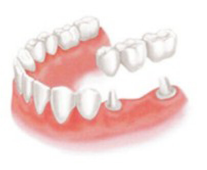 あい歯科クリニックのインプラント治療