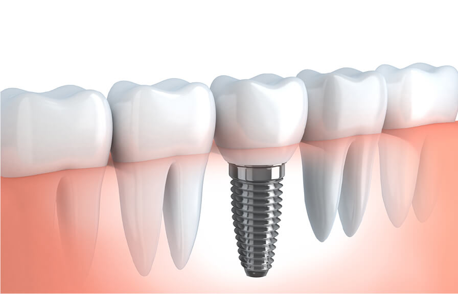 あい歯科クリニックのインプラント治療