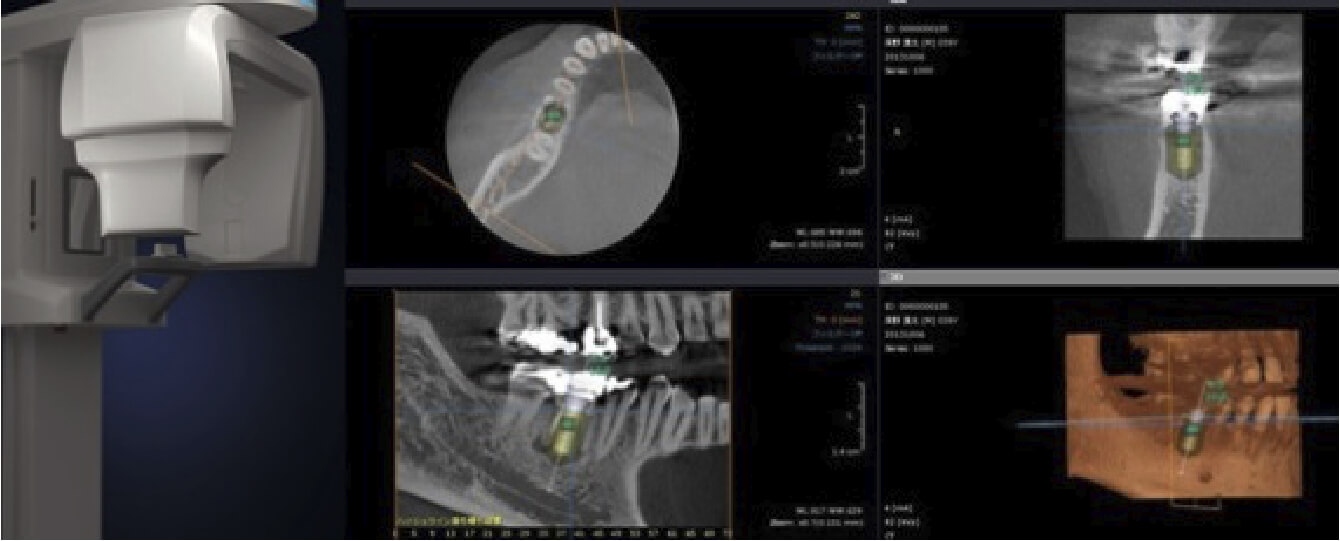 あい歯科クリニックのインプラント治療