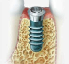あい歯科クリニックのインプラント治療