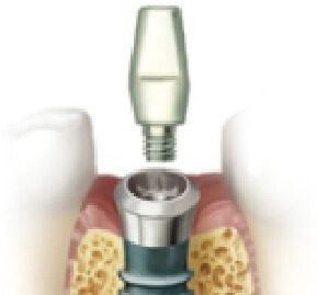 あい歯科クリニックのインプラント治療