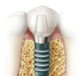 あい歯科クリニックのインプラント治療