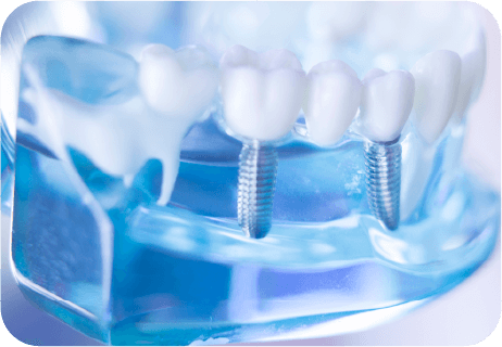 インプラント治療